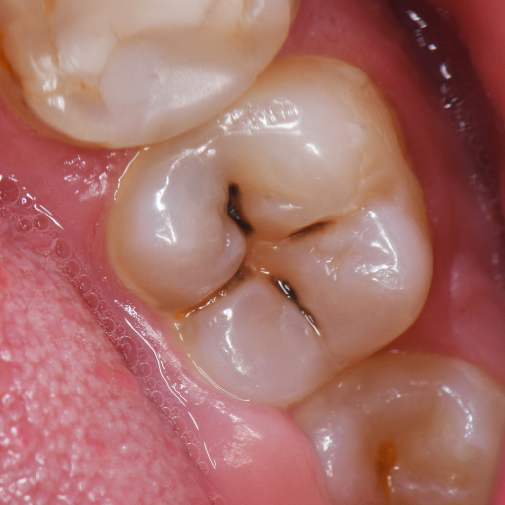Niño con Caries