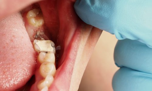 Caries Infantil